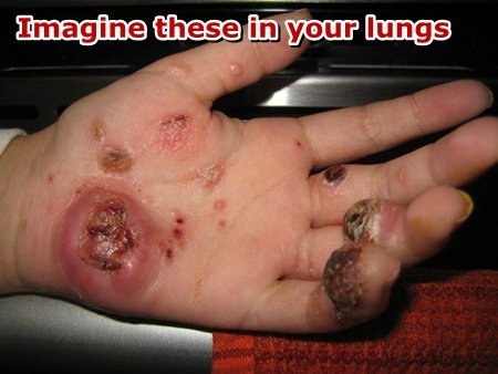 Hand with histiocytosis of the skin